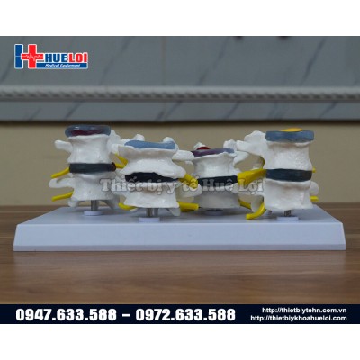 Mô hình đốt sống bình thường và bệnh lý